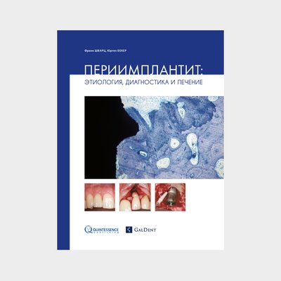 Периимплантит: Этиология, диагностика и лечение 6 фото
